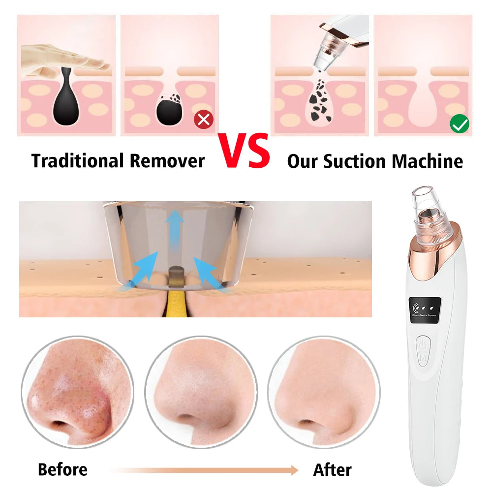 Serenity Luster Vacuum Blackhead Remover - Serenity Luster